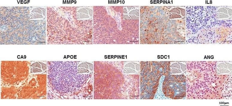 Immunohistochemistry: Serpin A1/alpha 1-Antitrypsin Antibody [NBP1-90309] - Representative expression status for ANG, CA9, MMP9, MMP10, SERPINA1, APOE, SDC1, VEGFA, serpine1 & IL8 levels in tumor tissue.Insert Representative expression status for ANG, CA9, MMP9, MMP10, SERPINA1, APOE, SDC1, VEGFA, serpine1 & IL-8 levels in benign tissue. All images were captured at 400× magnification. Image collected & cropped by CiteAb from the following publication (//diagnosticpathology.biomedcentral.com/articles/10.1186/s13000-014-0200-1), licensed under a CC-BY license. Not internally tested by Novus Biologicals.