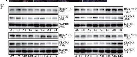  CLCN3 and HNRNPK were upregulated in LUAD and correlated with poor prognosis. (a, b) In paraffin-embedded LUAD tissue microarray, we discovered that the expression of CLCN3 and HNRNPK was elevated in LUAD tissues compared with ANT (n = 30). (c) The CLCN3 expression positively correlated with HNRNPK expression in LUAD tissues. (d) Using IF staining of LUAD tissue microarray, we found that both CLCN3 and HNRNPK were highly expressed in LUAD tissues (n = 30). (e) The Kaplan-Meier survival analysis illustrated that elevated CLCN3 or HNRNPK expression levels in tumors predicted a dismal prognosis for LUAD patients. In the HPA database, the data also suggested that the patients having an elevated expression of CLCN3 or HNRNPK exhibited a shorter overall survival. (f) LUAD and adjacent normal tissues were collected (16 cases), and the increased expression of CLCN3 or HNRNPK was confirmed in LUAD tissues (n = 16). (g) Correlation analysis indicated a positive expression correlation between CLCN3 and HNRNPK in 16 cases of LUAD tissues. *P < 0.05. Image collected and cropped by CiteAb from the following open publication (//pubmed.ncbi.nlm.nih.gov/36439880), licensed under a CC-BY license. Not internally tested by Novus Biologicals.