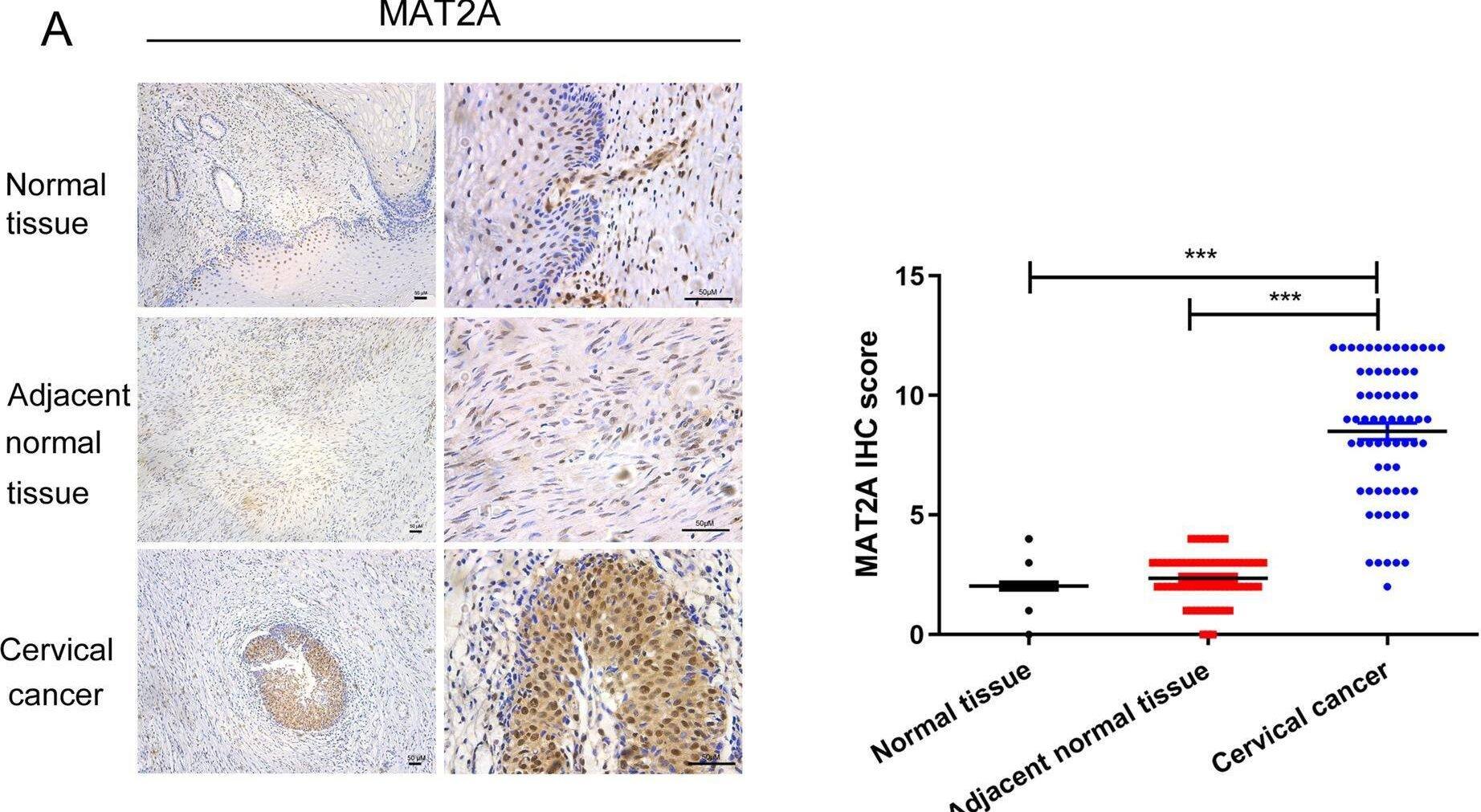 MAT2A and PDCD6 are highly expressed in cervical cancer tissues and are correlated with poor prognosis with cervical cancer patients.A Immunohistochemical staining with MAT2A antibody was performed in 67 cervical cancer specimens and 67 normal cervical specimens. Representative photos of tumors versus the normal tissue and adjacent normal tissues were shown (magnification: ×100 and ×400, left panel). Comparative analysis of MAT2A expression among normal cervical tissue, adjacent normal tissue and cervical cancer specimen was shown (right panel).***P < 0.001. Scar bars: 50 μM. B Immunohistochemical staining with PDCD6 antibody was performed in 67 cervical cancer specimens and 67 normal cervical specimens. Representative photos of tumors versus the normal tissue and adjacent normal tissue was shown (magnification: ×100 and ×400, left panel). Comparative analysis of PDCD6 expression among normal cervical tissue, adjacent normal tissue and cervical cancer specimen was shown (right panel). ***P < 0.001. Scar bars: 50 μM. C Semiquantitative scoring and correlation analysis indicating the correlation between MAT2A and PDCD6 (r = 0.819, P < 0.001). D Prognostic analysis of PDCD6 gene expression in cervical cancer patients (GEPIA2) was illustrated. Overall survival (OS) and disease-free survival (DFS) analysis were performed to show the survival status in the TCGA cohort via GEPIA2. Kaplan–Meier curves were plotted with P-values and HRs by log-rank tests and Cox regression models. Image collected and cropped by CiteAb from the following open publication (//pubmed.ncbi.nlm.nih.gov/35396512), licensed under a CC-BY license. Not internally tested by Novus Biologicals.