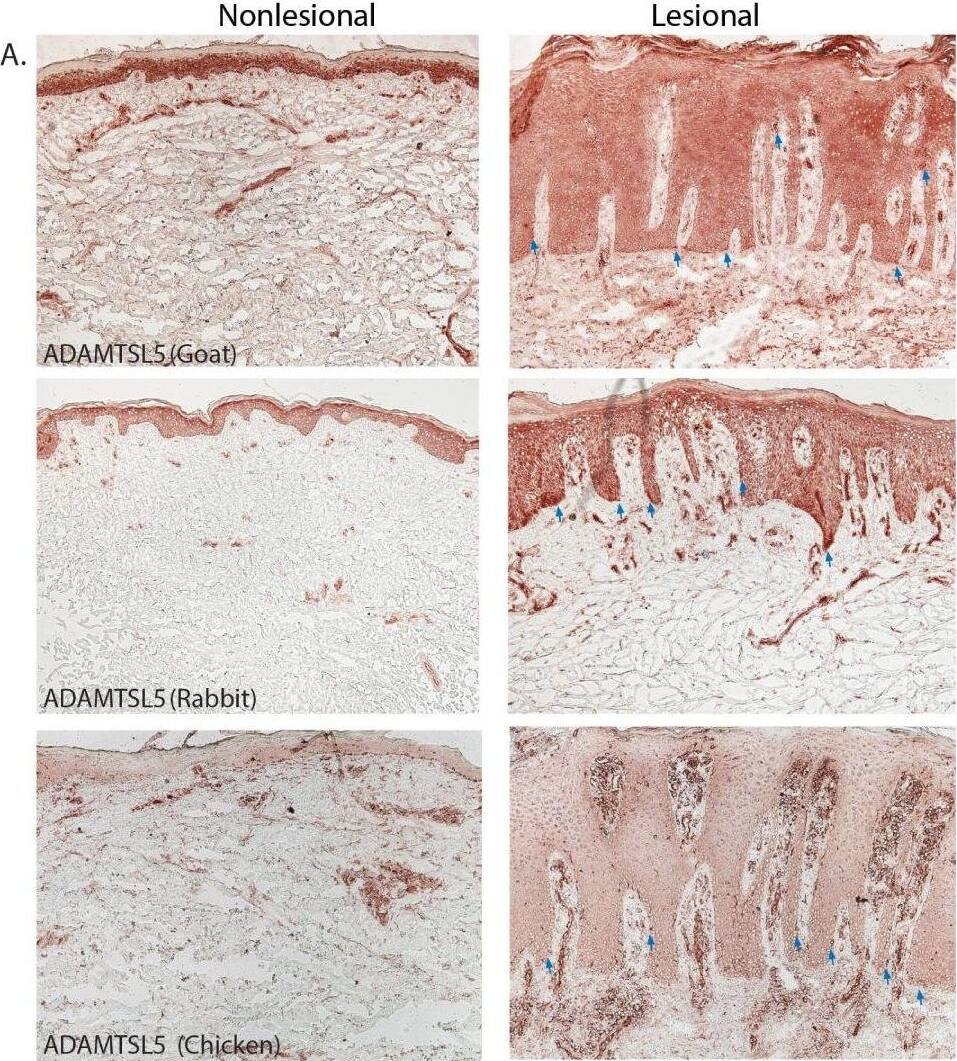 Immunohistochemistry: ADAMTSL5 Antibody [NBP1-93438] - Distribution of ADAMTSL5 in nonlesional & lesional psoriatic skin Representative images for immunohistochemistry staining of ADAMTSL5, Melan-A, & K16 in psoriasis nonlesional & lesional skin. There is widespread distribution & expression of ADAMTSL5 raised in goat, rabbit, & chicken in keratinocytes, melanocytes, blood vessels & dermal cells (A). The staining pattern is similar to melanocytes (Melan A) in the basal layer of the epidermis (B) & keratinocytes stained by K16 (C). The blue arrows indicate ADAMTSL5 expression in melanocytes in lesional psoriatic skin. Size bar = 100um. Image collected & cropped by CiteAb from the following publication (//pubmed.ncbi.nlm.nih.gov/27857980), licensed under a CC-BY license. Not internally tested by Novus Biologicals.
