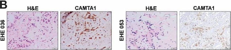 Derivation of EHE primary cell cultures and demonstration of the TAZ-CAMTA1 fusion protein (WWTR1-CAMTA1 fusion gene). (A) Table containing patient characteristics associated with EHE tumors. (B) H&E staining and immunohistochemical evaluation of CAMTA1 expression in EHE 036 and EHE 053. Images taken at 200X. (C) Schematic outlining generation and characterization of the extended primary cell cultures. (D) Image of primary cell cultures in a monolayer with insets at higher power. Arrow denotes tumor fragment of EHE 036. (E) Schematic representation of RNA Breakpoint for EHE 001 determined by RT-PCR. Codons with their associated amino acids are shown below. (F) Schematic representation of RNA Breakpoint for EHE 036 by anchored multiplex PCR from tumor RNA. Codons with their associated amino acid are shown below. (G) qRT-PCR utilizing custom probes hybridizing to the EHE 001 and EHE 036 breakpoints respectively, with HPAEC as a control. (H) Single-cell RNA sequencing of early passage EHE 001 (passage number 6) demonstrating expression of CAMTA1. (I) Single-cell RNA sequencing of early passage EHE 001 (passage number 6) demonstrating expression of FLI1. (J) Western blot, after enriching for the nuclear fraction, probing for TAZ in HPAEC control and the EHE extended primary cell cultures. Error bars were used to define one standard deviation. For all panels, ****p < 0.0001, *** p < 0.001, ** p < 0.01, *p < 0.05. Image collected and cropped by CiteAb from the following open publication (//pubmed.ncbi.nlm.nih.gov/41073554), licensed under a CC-BY license. Not internally tested by Novus Biologicals.