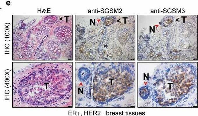 SGSM2 expression was detected in human breast tissues and human breast cancer cell lines. (a) SGSM2 mRNA expressions in normal and malignant tissues was determined in 53 BC patients via RT-PCR, and the gel band intensities were quantified with PhotoCaptMw software (version 11.0.). We used normalized SGSM2 expression to classify patients into three groups: T > N, N = T, and N > T (N = normal tissue, and T = tumour tissue); and further, (b) quantitative real-time PCR was used to evaluate SGSM2 mRNA expression profiles in paired human breast tumour (red lines) and normal (green lines) tissues (n = 200). (c) The means of SGSM2 mRNA copy number (per μg of mRNA) were calculated from real-time PCR data. The data were analysed with a paired sample t-test with two-sided P-values. (d) In vitro SGSM2 and SGSM3 protein expression was detected in twelve breast cancer cell lines and one breast epithelial cell line; the mean density of SGSM2 and SGSM3 protein level in each cell line was normalized to  beta -actin, and the values were compared to the MCF-10A cell line. The hormone receptor status is displayed at the bottom. (e) The distribution of SGSM2 and SGSM3 proteins were determined in ER+/ HER2 – breast cancer tissue sections; Haematoxylin (violet, for nuclei) and eosin (pink) (H&E) staining is shown in the left panels; anti-SGSM2 and anti-SGSM3 antibody bound to antigen is shown in the middle and right panels (N = normal region, T = tumour region). Top panels: 100x, scale bar: 100 μm; bottom panels: 400x, scale bar: 25 μm. Image collected and cropped by CiteAb from the following open publication (//pubmed.ncbi.nlm.nih.gov/30744493), licensed under a CC-BY license. Not internally tested by Novus Biologicals.