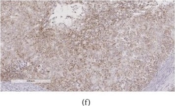 Immunohistochemistry: IGSF9 Antibody [NBP1-93676] - Histopathological & immunohistochemical evaluation of endometrial carcinoma. (a) & (b) H&E stain of endometrioid endometrial carcinoma, histological grades I & II, respectively; (c) & (d) Ki67 stain on grade I & II sections, respectively; (e) & (f) IGSF9 stain on grade I & II sections, respectively. Both immunostains were quantified with the image analysis tools from Aperio digital pathology system. Numeric data were used in statistical analysis. Image collected & cropped by CiteAb from the following publication (//pubmed.ncbi.nlm.nih.gov/29666643), licensed under a CC-BY license. Not internally tested by Novus Biologicals.