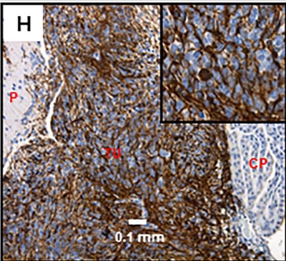 Immunohistochemistry-Paraffin: Vimentin Antibody (RV203) - BSA Free [NBP1-97671] - BTIC markers in our CNS-PNET model tumors.A: Ki67, 20X, insert- 5X digital (LCAS-R-12 weeks post-injection) B: Oct3/4, 40x, insert- 5X digital (LCAS-R-12 weeks post-injection) C: Nestin 20x, insert- 5X digital (LCAS-R-12 weeks post-injection) D: Nestin 40x, insert- 5X digital (LCAS-R-12 weeks post-injection) E: Sox2 40X, insert- 5X digital, (LC26-R-12 weeks post-injection) F: Sox2 40X, insert- 5X digital (LCAS-R-12 weeks post-injection) G: Vimentin 5X, insert- 5X digital (LCAS-R-12 weeks post-injection) H: Vimentin 20X, insert- 5X digital (LC26-R-12 weeks post-injection) TU-tumor; P-parenchyma; V-ventricle; CP-choroid plexus. Image collected & cropped by CiteAb from the following publication (//dx.plos.org/10.1371/journal.pone.0173106), licensed under a CC-BY license. Not internally tested by Novus Biologicals.