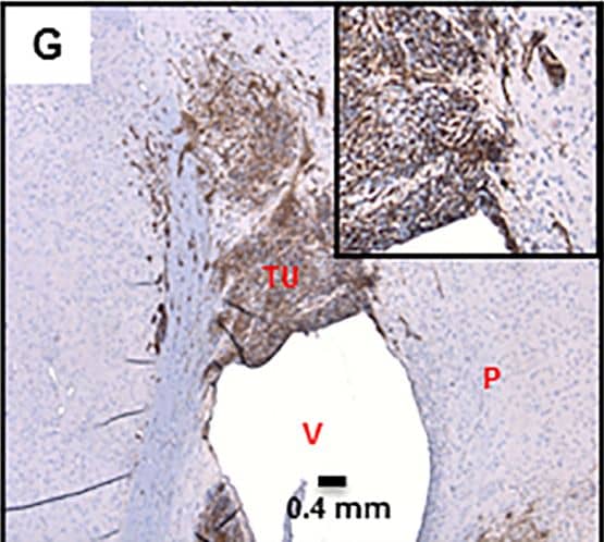 Immunohistochemistry-Paraffin: Vimentin Antibody (RV203) - BSA Free [NBP1-97671] - BTIC markers in our CNS-PNET model tumors.A: Ki67, 20X, insert- 5X digital (LCAS-R-12 weeks post-injection) B: Oct3/4, 40x, insert- 5X digital (LCAS-R-12 weeks post-injection) C: Nestin 20x, insert- 5X digital (LCAS-R-12 weeks post-injection) D: Nestin 40x, insert- 5X digital (LCAS-R-12 weeks post-injection) E: Sox2 40X, insert- 5X digital, (LC26-R-12 weeks post-injection) F: Sox2 40X, insert- 5X digital (LCAS-R-12 weeks post-injection) G: Vimentin 5X, insert- 5X digital (LCAS-R-12 weeks post-injection) H: Vimentin 20X, insert- 5X digital (LC26-R-12 weeks post-injection) TU-tumor; P-parenchyma; V-ventricle; CP-choroid plexus. Image collected & cropped by CiteAb from the following publication (//dx.plos.org/10.1371/journal.pone.0173106), licensed under a CC-BY license. Not internally tested by Novus Biologicals.