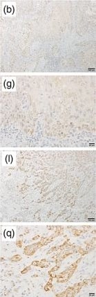 Immunohistochemistry: RGS5 Antibody (OTI1C1) [NBP2-00880] - Representative photomicrographs of hematoxylin & eosin (H&E), CK5/6, regulator of G‐protein signaling (RGS) 5, N‐cadherin, vimentin, & E‐cadherin in squamous cell carcinoma of the tongue in noninvasive & invasive portions. (a), (b), (c), (d), & (e) show H&E, RGS5, N‐cadherin, vimentin, & E‐cadherin in noninvasive portions at 10× magnification. (f), (g), (h), (i), & (j) show H&E, RGS5, N‐cadherin, vimentin, & E‐cadherin in noninvasive portions at 40× magnification. (k), (l), (m), (n), & (o) show H&E, RGS5, N‐cadherin, vimentin, & E‐cadherin in invasive portions at 10× magnification. (p), (q), (r), (s), & (t) show H&E, RGS5, N‐cadherin, vimentin, & E‐cadherin in invasive portions at 40× magnification Image collected & cropped by CiteAb from the following publication (//pubmed.ncbi.nlm.nih.gov/31049219), licensed under a CC-BY license. Not internally tested by Novus Biologicals.