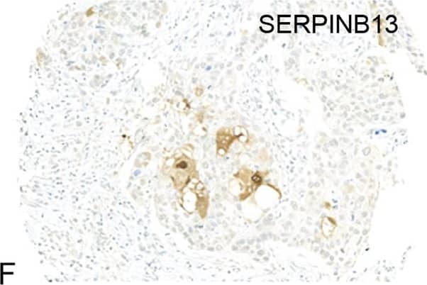 Immunohistochemistry: SERPINB13 Antibody (OTI2B6) [NBP2-01312] - Cytoplasmic staining was detected for (a) MTSS1, (b) SCAMP1 & (c) Serpin B13 protein in the malignant epithelium of breast cancer. Alternatively, the majority of ‘pure’ HER2+ (HER2+/ER−/PR−) tumours showed loss or in (d) MTSS1, (e) SCAMP1 & (f) SERPIN B13 staining. g Distribution of MTSS1, SCAMP1 & SERPIN B13 in the ‘pure’ HER2 patient class versus other tumour classes Image collected & cropped by CiteAb from the following publication (//www.nature.com/articles/s41419-018-0364-9), licensed under a CC-BY license. Not internally tested by Novus Biologicals.