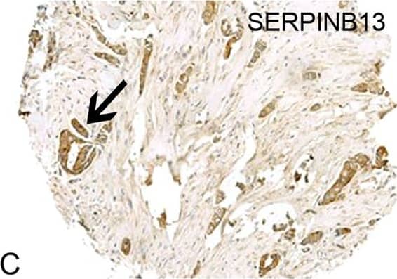 Immunohistochemistry: SERPINB13 Antibody (OTI2B6) [NBP2-01312] - Cytoplasmic staining was detected for (a) MTSS1, (b) SCAMP1 & (c) Serpin B13 protein in the malignant epithelium of breast cancer. Alternatively, the majority of ‘pure’ HER2+ (HER2+/ER−/PR−) tumours showed loss or in (d) MTSS1, (e) SCAMP1 & (f) SERPIN B13 staining. g Distribution of MTSS1, SCAMP1 & SERPIN B13 in the ‘pure’ HER2 patient class versus other tumour classes Image collected & cropped by CiteAb from the following publication (//www.nature.com/articles/s41419-018-0364-9), licensed under a CC-BY license. Not internally tested by Novus Biologicals.
