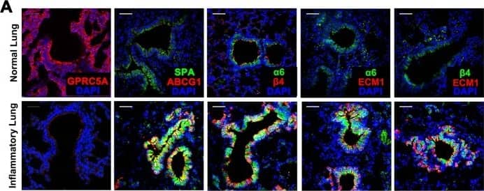 Immunocytochemistry/ Immunofluorescence: Surfactant Protein A Antibody [NBP2-12928] - ECM1-alpha 6 beta 4-ABCG1 axis is enriched in the S/TB region of the lungs in patients with pneumonia.IF analysis of GPRC5A, SPA/ABCG1,  alpha 6/ beta 4,  alpha 6/ECM1 &  beta 4/ECM1 in normal or pneumonic lung tissue samples (a) & the calculation of positive or dual-positive cells in the S/TB region (b), (Bar = 100 µm); c Graphical abstract of the study: GPRC5A deficiency promotes the activation of NF-kB & subsequent expression & secretion of ECM1; the secreted ECM1 interacts with  alpha 6 beta 4 of AT2 cells & induces the activation of NF-kB, which induces the expression of ABCG1. AT2 cells with ABCG1 expression are one of the originating cell populations of lung cancer. Data were collected from three independent experiments with triplicate samples. **P < 0.01; ***P < 0.001. Image collected & cropped by CiteAb from the following publication (//pubmed.ncbi.nlm.nih.gov/32157214), licensed under a CC-BY license. Not internally tested by Novus Biologicals.