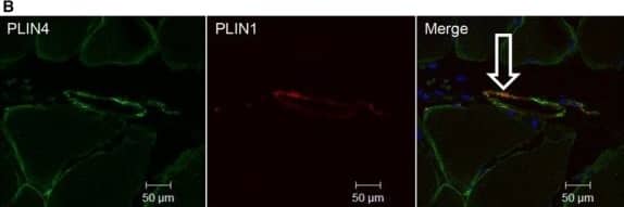 Intramuscular adipocytes. (A) Sections of paraffin-embedded biopsies from m. vastus lateralis (n = 8) were stained with PLIN1 antibody (red, mouse anti-PLIN1) to detect adipocytes (A). Representative images (200X) were obtained by wide-field fluorescence microscopy. High magnification (1000X) of adipocytes is shown in the insert. (B) The sections were stained for PLIN4 (green, rabbit anti-PLIN4) and PLIN1 (red, mouse anti-PLIN1), showing partly co-localization in intramuscular adipocytes (n = 4). The merged image (200X) shows co-localization of the proteins (white arrow). The image was obtained by confocal fluorescence microscopy. Image collected and cropped by CiteAb from the following open publication (//pubmed.ncbi.nlm.nih.gov/26265748), licensed under a CC-BY license. Not internally tested by Novus Biologicals.