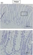 Immunohistochemistry-Paraffin: PKM1 Antibody - BSA Free [NBP2-14833] - Expression of PKM1 & PKM2 in clinical colorectal cancer samples.(a) The protein expression of PKM1 & PKM2 in clinical specimens of cancer tumor (T) & the adjacent normal tissues (N) is shown. PKM1 & PKM2 were detected by Western blotting in under the same experimental conditions at the same time. The full-length blots are presented in Supplementary Figure S3b. (b–d) Immunohistochemical staining of normal colon tissue adjacent to tumor tissue of case 10. Results of H&E staining (b), staining with anti-PKM1 antibody (c), & staining with anti-PKM2 (d) are shown. The boxed regions in “c” & “d” are enlarged in the images below. (e–h) Immunohistochemical staining of clinical colorectal cancer tissue specimen of representative case 3. H&E-stained section with normal tissue (upper right corner) neighboring the tumor area in the section is shown (e), along with the same section stained with anti-PKM2 antibody (f). Enlarged views of boxed areas in “f” show normal colorectal crypt in mucosa (g) & tumor area (h) stained with anti-PKM2 antibody. Image collected & cropped by CiteAb from the following publication (//www.nature.com/articles/srep08647), licensed under a CC-BY license. Not internally tested by Novus Biologicals.