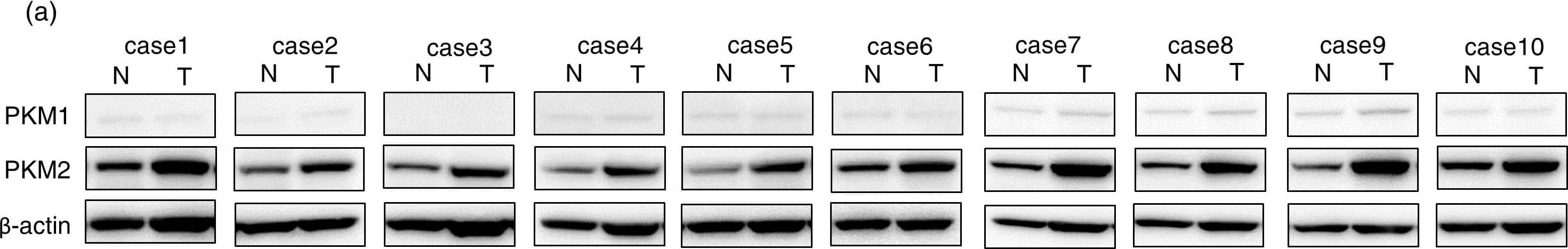 Western Blot: PKM1 Antibody - BSA Free [NBP2-14833] - Expression of PKM1 & PKM2 in clinical colorectal cancer samples.(a) The protein expression of PKM1 & PKM2 in clinical specimens of cancer tumor (T) & the adjacent normal tissues (N) is shown. PKM1 & PKM2 were detected by Western blotting in under the same experimental conditions at the same time. The full-length blots are presented in Supplementary Figure S3b. (b–d) Immunohistochemical staining of normal colon tissue adjacent to tumor tissue of case 10. Results of H&E staining (b), staining with anti-PKM1 antibody (c), & staining with anti-PKM2 (d) are shown. The boxed regions in “c” & “d” are enlarged in the images below. (e–h) Immunohistochemical staining of clinical colorectal cancer tissue specimen of representative case 3. H&E-stained section with normal tissue (upper right corner) neighboring the tumor area in the section is shown (e), along with the same section stained with anti-PKM2 antibody (f). Enlarged views of boxed areas in “f” show normal colorectal crypt in mucosa (g) & tumor area (h) stained with anti-PKM2 antibody. Image collected & cropped by CiteAb from the following publication (//www.nature.com/articles/srep08647), licensed under a CC-BY license. Not internally tested by Novus Biologicals.