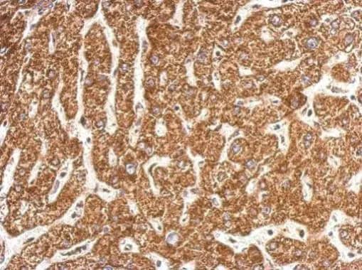 Immunohistochemistry: NDUFB4 Antibody [NBP2-15035] - NDUFB4 antibody detects NDUFB4 protein at cytosol on human hepatoma by immunohistochemical analysis. Sample: Paraffin-embedded hepatoma. NDUFB4 antibody (NBP2-15035) dilution: 1:500.Antigen Retrieval: Trilogy™ (EDTA based, pH 8.0) buffer, 15min