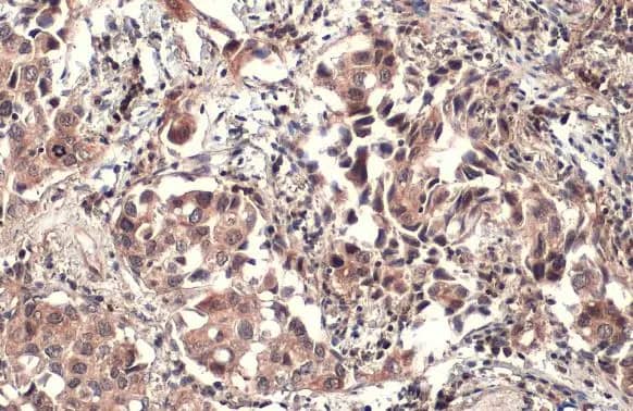 Immunohistochemistry-Paraffin: PTPN14/PTPD2 Antibody [NBP2-15069] - PTPN14/PTPD2 antibody [C2C3], C-term detects PTPN14/PTPD2 protein at cytoplasm by immunohistochemical analysis.Sample: Paraffin-embedded human lung cancer.PTPN14/PTPD2 stained by PTPN14/PTPD2 antibody [C2C3], C-term (NBP2-15069) diluted at 1:500.Antigen Retrieval: Citrate buffer, pH 6.0, 15 min