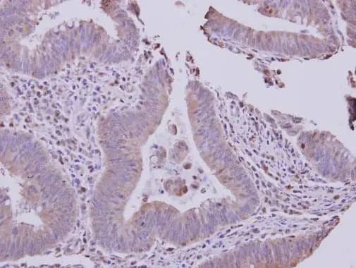 Immunohistochemistry: solute carrier family 22, member 18 antisense Antibody [NBP2-15120] - solute carrier family 22, member 18 antisense antibody detects solute carrier family 22, member 18 antisense protein at cytoplasm on human colon carcinoma by immunohistochemical analysis. Sample: Paraffin-embedded colon carcinoma. solute carrier family 22, member 18 antisense antibody (NBP2-15120) dilution: 1:500.Antigen Retrieval: Trilogy™ (EDTA based, pH 8.0) buffer, 15min