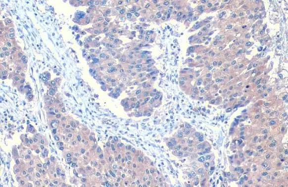 Immunohistochemistry-Paraffin: Angiopoietin-like Protein 3/ANGPTL3 Antibody [NBP2-15390] - Angiopoietin-like Protein 3/ANGPTL3 antibody detects Angiopoietin-like Protein 3/ANGPTL3 protein at cytoplasm by immunohistochemical analysis.Sample: Paraffin-embedded human hepatocellular carcinoma.Angiopoietin-like Protein 3/ANGPTL3 stained by Angiopoietin-like Protein 3/ANGPTL3 antibody (NBP2-15390) diluted at 1:500.Antigen Retrieval: Citrate buffer, pH 6.0, 15 min