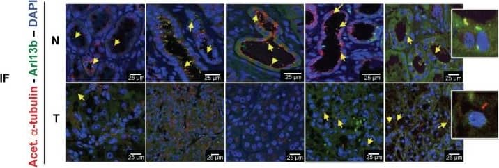 Immunocytochemistry/ Immunofluorescence: ARL13B Antibody [NBP2-15463] -  Identification & validation of the 2-gene signature predictive of the presence of VDAC1-delta C & the primary cilium of ccRCC patients from 19 ccRCC patients. A, The mRNA (2-gene signature) & immunofluorescence (Acetyl. a-Tubulin, Arl13b & DAPI) of tumors samples of 12 patients were studied to evaluate the prediction model of the absence or presence of the primary cilium. Normal tissues (N) & tumoral tissues (T). B, Representative image of immunohistochemistry (IHC) analysis of the 19 patients studied to evaluate a prediction model of the absence or presence of the primary cilium. C, Percentage of ciliated cells in normal & tumor tissues from patients. A *** p<0.0005 show significant differences. Image collected & cropped by CiteAb from the following publication (//pubmed.ncbi.nlm.nih.gov/32194829), licensed under a CC-BY license. Not internally tested by Novus Biologicals.