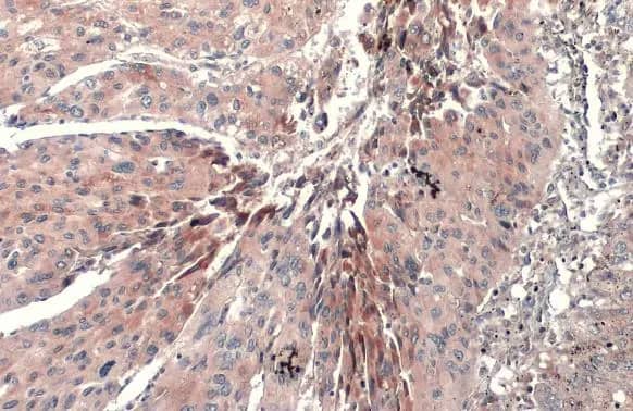 Immunohistochemistry-Paraffin: CETP Antibody [NBP2-15867] - CETP antibody [N1N3] detects CETP protein at cytoplasm by immunohistochemical analysis.Sample: Paraffin-embedded human hepatocellular carcinoma.CETP stained by CETP antibody [N1N3] (NBP2-15867) diluted at 1:500.Antigen Retrieval: Citrate buffer, pH 6.0, 15 min