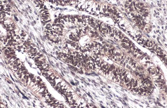 FOXM1 antibody detects FOXM1 protein at nucleus by immunohistochemical analysis.Sample: Paraffin-embedded human endometrial carcinoma.FOXM1 stained by FOXM1 antibody (NBP2-16520) diluted at 1:500.Antigen Retrieval: Citrate buffer, pH 6.0, 15 min 