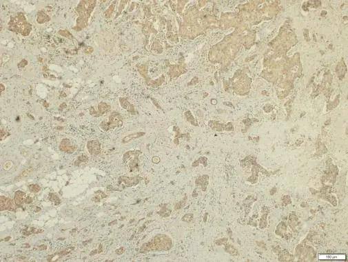 FSTL1 antibody [N1C3] detects FSTL1 protein at cytosol on human breast carcinoma by immunohistochemical analysis. Sample: Paraffin-embedded human breast carcinoma. FSTL1 antibody [N1C3] (NBP2-16541) dilution: 1:250.Scale bar = 100 um. br>Antigen Retrieval: Trilogy(TM) (EDTA based, pH 8.0) buffer, 15min 