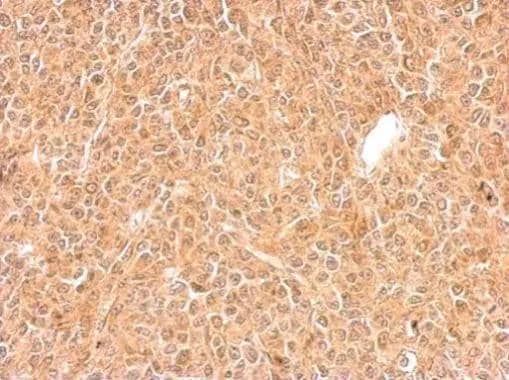 GGPS1 antibody detects GGPS1 protein at cytosol on BT483 xenograft by immunohistochemical analysis. Sample: Paraffin-embedded BT483 xenograft. GGPS1 antibody (NBP2-16652) dilution: 1:500. Antigen Retrieval: Trilogy(TM) (EDTA based, pH 8.0) buffer, 15min 