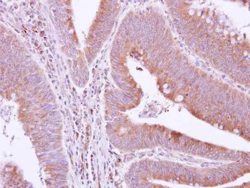 GRAP antibody [N1C3] detects GRAP protein at cytoplasm on human colon carcinoma by immunohistochemical analysis. Sample: Paraffin-embedded colon carcinoma. GRAP antibody [N1C3] (NBP2-16737) dilution: 1:500. br>Antigen Retrieval: Trilogy(TM) (EDTA based, pH 8.0) buffer, 15min 