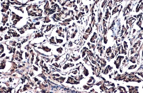 GSTP1 antibody detects GSTP1 protein at cytoplasm and nucleus by immunohistochemical analysis.Sample: Paraffin-embedded human breast carcinoma.GSTP1 stained by GSTP1 antibody (NBP2-16757) diluted at 1:500.Antigen Retrieval: Citrate buffer, pH 6.0, 15 min 