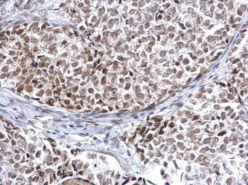 HDAC2 antibody detects HDAC2 protein at nucleus on human breast carcinoma by immunohistochemical analysis. Sample: Paraffin-embedded human breast carcinoma. HDAC2 antibody (NBP2-16790) diluted at 1:500. br>Antigen Retrieval: Trilogy(TM) (EDTA based, pH 8.0) buffer, 15min 