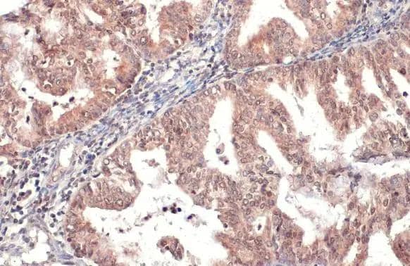 HYAL1 antibody detects HYAL1 protein at cytoplasm by immunohistochemical analysis.Sample: Paraffin-embedded human endometrial carcinoma.HYAL1 stained by HYAL1 antibody (NBP2-16906) diluted at 1:500.Antigen Retrieval: Citrate buffer, pH 6.0, 15 min 