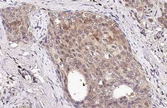 ICAM2 antibody [N1C3] detects ICAM2 protein at cell membrane and cytoplasm by immunohistochemical analysis.Sample: Paraffin-embedded human breast carcinoma.ICAM2 stained by ICAM2 antibody [N1C3] (NBP2-16912) diluted at 1:500.Antigen Retrieval: Citrate buffer, pH 6.0, 15 min 