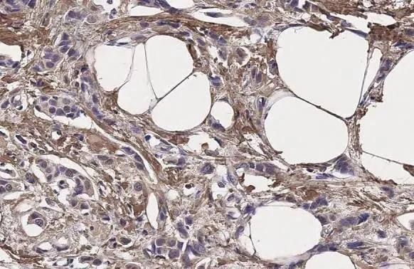 IL13 Receptor alpha 1 antibody [N1C1] detects IL13 Receptor alpha 1 protein at cell membrane and cytoplasm by immunohistochemical analysis.Sample: Paraffin-embedded human breast carcinoma.IL13 Receptor alpha 1 stained by IL13 Receptor alpha 1 antibody [N1C1] (NBP2-16943) diluted at 1:500.Antigen Retrieval: Citrate buffer, pH 6.0, 15 min 