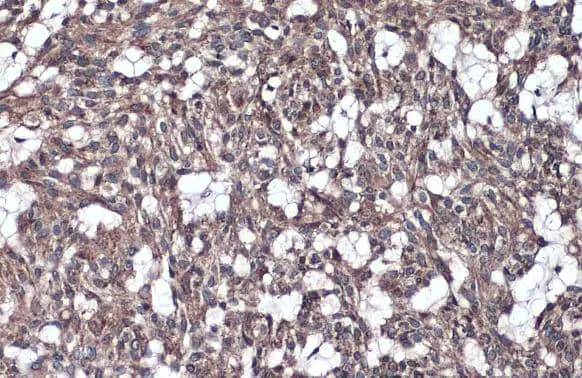 IL1RAP antibody [N1N3] detects IL1RAP protein at cell membrane and cytoplasm by immunohistochemical analysis.Sample: Paraffin-embedded human breast carcinoma.IL1RAP stained by IL1RAP antibody [N1N3] (NBP2-16946) diluted at 1:300.Antigen Retrieval: Citrate buffer, pH 6.0, 15 min 