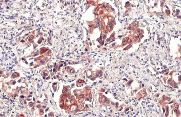 Immunohistochemistry-Paraffin: IL-6 Antibody [NBP2-16957] - IL-6 antibody detects IL-6 protein at cell membrane and cytoplasm by immunohistochemical analysis.Sample: Paraffin-embedded human lung cancer.IL-6 stained by IL-6 antibody (NBP2-16957) diluted at 1:500.Antigen Retrieval: Citrate buffer, pH 6.0, 15 min