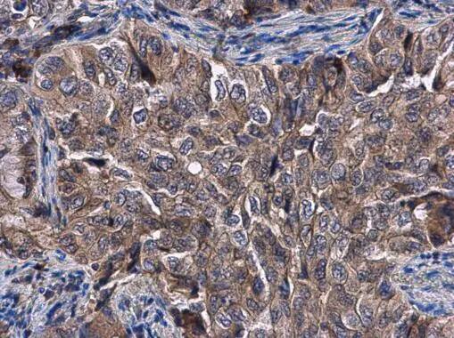Immunohistochemistry-Paraffin: Kelch-Like 3 Antibody [NBP2-17037] - Kelch-Like 3 antibody [N1C1] detects Kelch-Like 3 protein at cytoplasm in human lung cancer by immunohistochemical analysis. Sample: Paraffin-embedded human lung cancer. Kelch-Like 3 antibody [N1C1] (NBP2-17037) diluted at 1:400.Antigen Retrieval: Citrate buffer, pH 6.0, 15 min