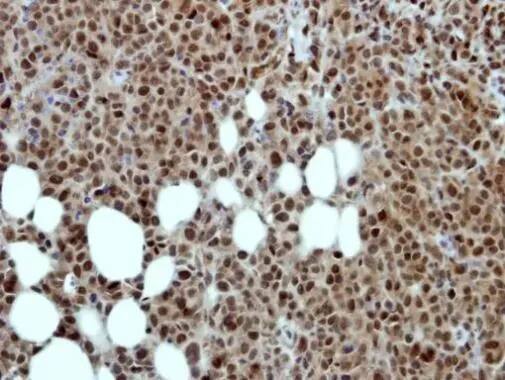 Immunohistochemistry: MED17 Antibody [NBP2-17256] - Immunohistochemical analysis of paraffin-embedded HBL435 xenograft, using MED17(NBP2-17256) antibody at 1:500 dilution.Antigen Retrieval: Citrate buffer, pH 6.0, 15 min