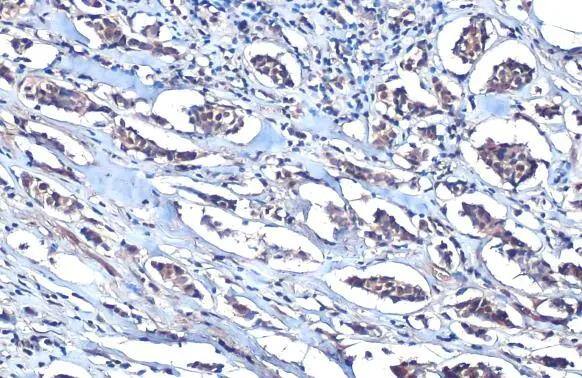 MEF2C antibody detects MEF2C protein at cytoplasm and nucleus by immunohistochemical analysis.Sample: Paraffin-embedded human breast carcinoma.MEF2C stained by MEF2C antibody (NBP2-17260) diluted at 1:250.Antigen Retrieval: Citrate buffer, pH 6.0, 15 min 