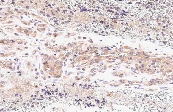 Immunohistochemistry-Paraffin: MTHFD2 Antibody [NBP2-19429] - MTHFD2 antibody [N3C3] detects MTHFD2 protein at mitochondria by immunohistochemical analysis.Sample: Paraffin-embedded human glioblastoma.MTHFD2 stained by MTHFD2 antibody [N3C3] (NBP2-19429) diluted at 1:500.Antigen Retrieval: Citrate buffer, pH 6.0, 15 min