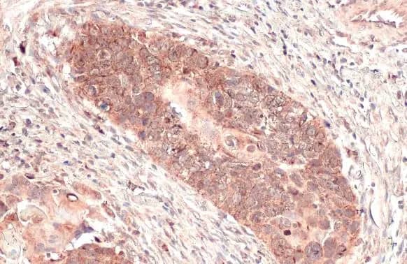 Immunohistochemistry-Paraffin: mtTFA Antibody [NBP2-19438] - mtTFA antibody detects mtTFA protein at mitochondria by immunohistochemical analysis.Sample: Paraffin-embedded human esophageal carcinoma.mtTFA stained by mtTFA antibody (NBP2-19438) diluted at 1:165.Antigen Retrieval: Citrate buffer, pH 6.0, 15 min