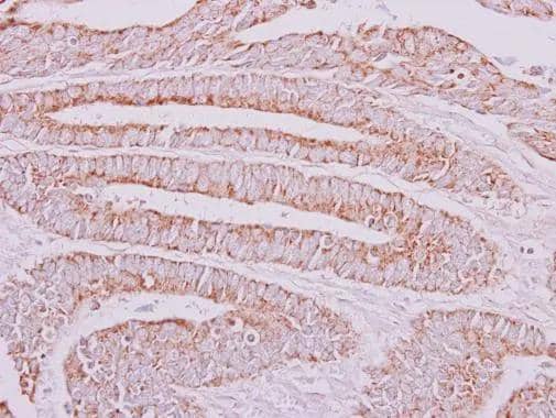 OXSM antibody detects OXSM protein at mitochondria on human colon carcinoma by immunohistochemical analysis. Sample: Paraffin-embedded colon carcinoma. OXSM antibody (NBP2-19648) dilution: 1:250. br>Antigen Retrieval: Trilogy(TM) (EDTA based, pH 8.0) buffer, 15min 