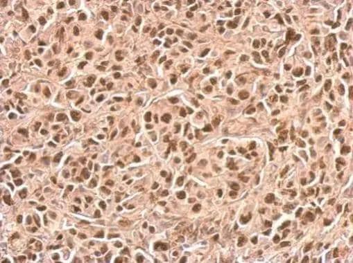 p21 Cip1 antibody detects CDKN1A protein at nucleus on SkHep1xenograft by immunohistochemical analysis. Sample: Paraffin-embedded SkHep1xenograft. p21 Cip1 antibody (NBP2-19652) dilution: 1:500. br>Antigen Retrieval: Trilogy(TM) (EDTA based, pH 8.0) buffer, 15min 