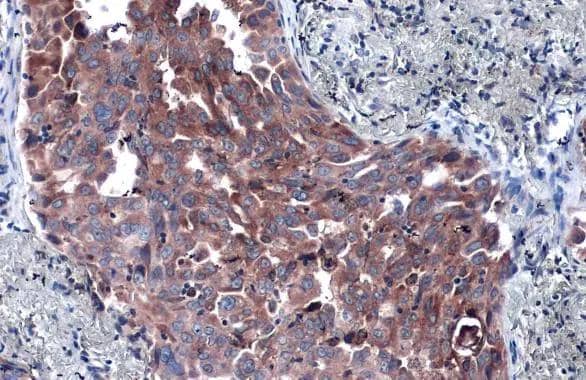 P4HA1 antibody [C1C3] detects P4HA1 protein at cytoplasm by immunohistochemical analysis.Sample: Paraffin-embedded human lung cancer.P4HA1 stained by P4HA1 antibody [C1C3] (NBP2-19664) diluted at 1:1000.Antigen Retrieval: Citrate buffer, pH 6.0, 15 min 