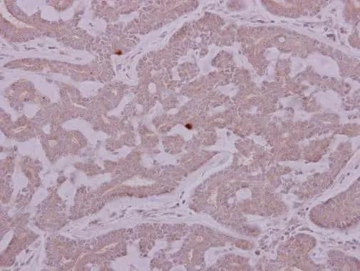 Immunohistochemistry: PCYT2 Antibody [NBP2-19735] - PCYT2 antibody detects PCYT2 protein at cytoplasm on human breast cancer by immunohistochemical analysis. Sample: Paraffin-embedded breast cancer. PCYT2 antibody (NBP2-19735) dilution: 1:500.Antigen Retrieval: Trilogy™ (EDTA based, pH 8.0) buffer, 15min