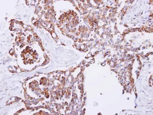 Immunohistochemistry: PITRM1 Antibody [NBP2-19843] - PITRM1 antibody detects PITRM1 protein at cytosol on human breast carcinoma by immunohistochemical analysis. Sample: PITRM1 antibody (NBP2-19843) dilution: 1:250.Antigen Retrieval: Trilogy™ (EDTA based, pH 8.0) buffer, 15min