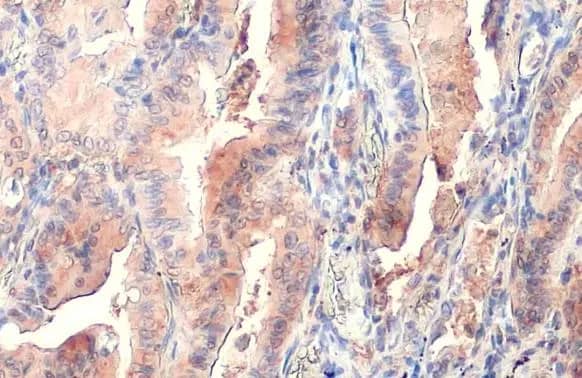 Immunohistochemistry-Paraffin: PKM2 Antibody [NBP2-19852] - PKM2 antibody detects PKM2 protein at cytoplasm by immunohistochemical analysis.Sample: Paraffin-embedded human lung cancer.PKM2 stained by PKM2 antibody (NBP2-19852) diluted at 1:500.Antigen Retrieval: Citrate buffer, pH 6.0, 15 min