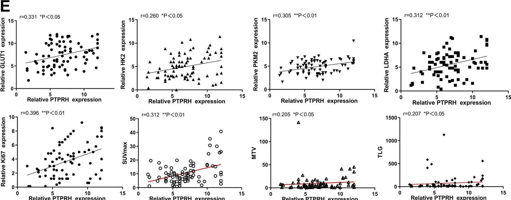 Correlation of PTPRH expression with 18F-fluorodeoxyglucose (18F-FDG) semiquantitative indicators, the expression of proliferation markers and the expression of glycolysis-related proteins. A, B Detection of PTPRH expression by immunohistochemistry (×400). C Correlation of PTPRH expression with 18F-FDG accumulation and the expression levels of Ki67. D In patients with high levels of PTPRH expression, immunohistochemical staining revealed high expression levels of GLUT1, HK2, PKM2, and LDHA (×400), whereas patients with low levels of PTPRH expression expressed low levels of GLUT1, HK2, PKM2 and LDHA (× 400). E The expression levels of PTPRH correlated positively with SUVmax, MTV, and TLG values and the expression of Ki67, GLUT1, HK2, PKM2, LDHA. 18F-FDG: 18F-fluorodeoxyglucose; GLUT1: glucose transporter type 1; HK2: hexokinase 2; PKM2: pyruvate kinase M2; LDHA: lactate dehydrogenase A; SUVmax: maximum standard uptake value Image collected and cropped by CiteAb from the following open publication (//pubmed.ncbi.nlm.nih.gov/37974250), licensed under a CC-BY license. Not internally tested by Novus Biologicals.