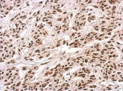 PUF60 antibody detects PUF60 protein at nucleus on U251 xenograft by immunohistochemical analysis. Sample: Paraffin-embedded U251 xenograft. PUF60 antibody (NBP2-20007) dilution: 1:500.Antigen Retrieval: Trilogy(TM) (EDTA based, pH 8.0) buffer, 15min 