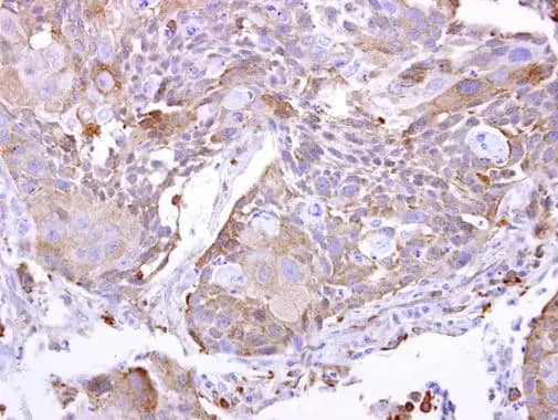 Immunohistochemistry: PYROXD2 Antibody [NBP2-20022] - PYROXD2 antibody [N2C2], Internal detects PYROXD2 protein at cytoplasm on human breast cancer by immunohistochemical analysis. Sample: Paraffin-embedded breast cancer. PYROXD2 antibody [N2C2], Internal (NBP2-20022) dilution: 1:500.Antigen Retrieval: Trilogy&trade; (EDTA based, pH 8.0) buffer, 15min