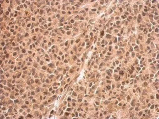 RED antibody detects IK protein at cytosol and nucleus on HeLa xenograft by immunohistochemical analysis. Sample: Paraffin-embedded HeLa xenograft. RED antibody (NBP2-20120) dilution: 1:500. br>Antigen Retrieval: Trilogy(TM) (EDTA based, pH 8.0) buffer, 15min 