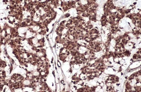 RelB antibody detects RelB protein at cytoplasm and nucleus by immunohistochemical analysis.Sample: Paraffin-embedded human breast carcinoma.RelB stained by RelB antibody (NBP2-20123) diluted at 1:500.Antigen Retrieval: Citrate buffer, pH 6.0, 15 min 