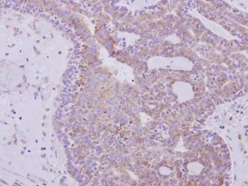 RPL6 antibody detects RPL6 protein at cytoplasm on human lung carcinoma by immunohistochemical analysis. Sample: Paraffin-embedded lung carcinoma. RPL6 antibody (NBP2-20216) dilution: 1:500. br>Antigen Retrieval: Trilogy(TM) (EDTA based, pH 8.0) buffer, 15min 